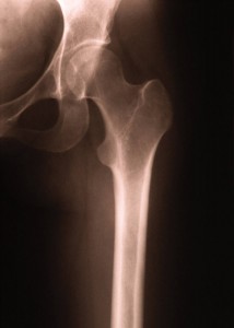 Hip X-ray